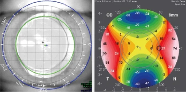 Corneal measurement screens: a centration capture of the eye beside a color-coded corneal topography map