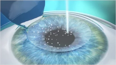 Illustration of LASIK: a corneal flap folded open while the excimer laser reshapes the exposed tissue