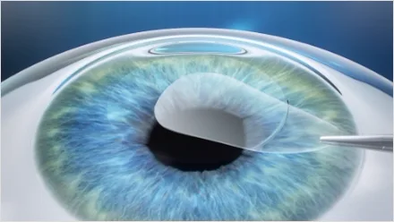 Illustration of SMILE: a thin lenticule being drawn out of the cornea through a small side incision