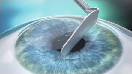 Illustration of LASEK: an instrument removing the corneal epithelium from the eye surface
