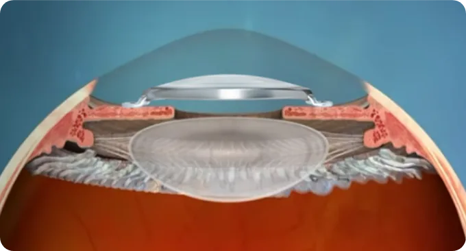 Cross-section of the eye showing the ArtiPLUS lens positioned in the anterior chamber with the natural lens preserved behind it
