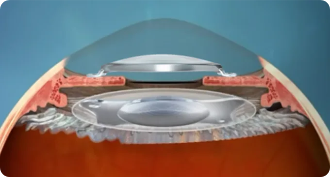 Cross-section of the eye showing the anterior chamber lens above the preserved crystalline lens from a wider angle