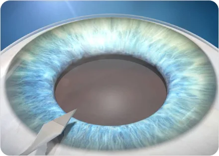 3D illustration of a micro-incision instrument entering the eye at the edge of the cornea