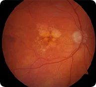 Fundus photograph associated with macular degeneration