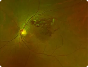 Fundus photograph showing retinal hemorrhage of the kind seen in retinal vein occlusion