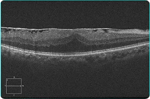 OCT scan of the macula of the kind used to assess an epiretinal membrane