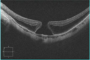 OCT scan showing a full-thickness macular hole