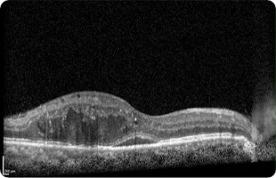 OCT scan showing macular swelling of the kind caused by diabetic retinopathy