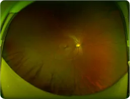 Wide-angle fundus photograph of the kind used to assess retinal detachment