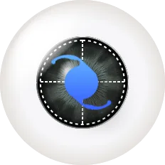Illustration of an intraocular lens dislocated from its normal position