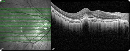 Fundus image and OCT scan of the kind used to assess myopic choroidal neovascularization