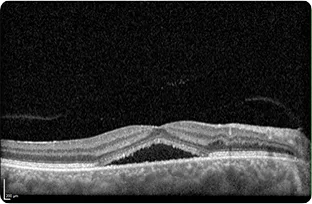 OCT scan showing fluid under the retina, as seen in central serous chorioretinopathy