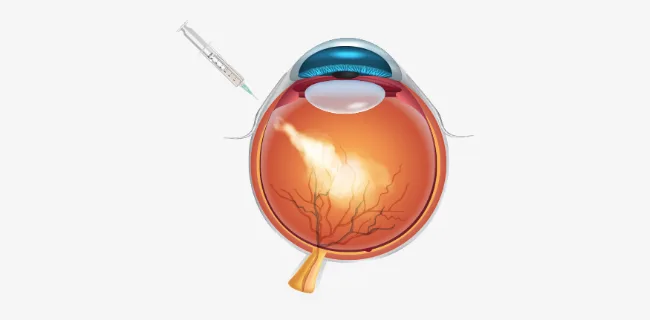 Illustration of an injection delivering medicine into the vitreous cavity of the eye
