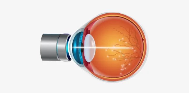 Illustration of a laser beam directed through the front of the eye onto the retina